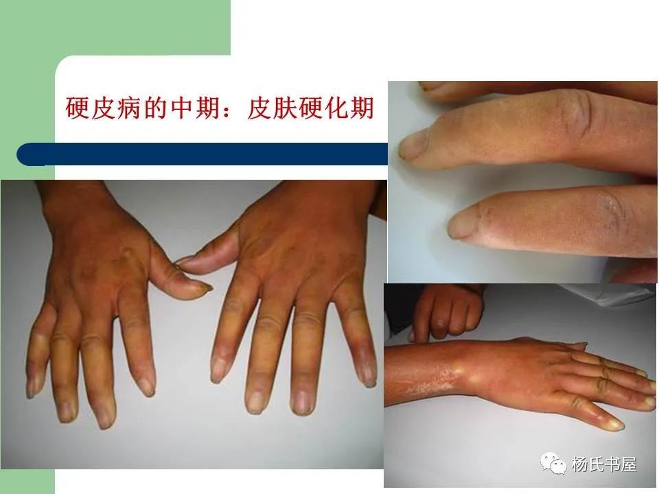 疾病科普 | 硬皮病的临床诊治经验 - 紫贝壳公益