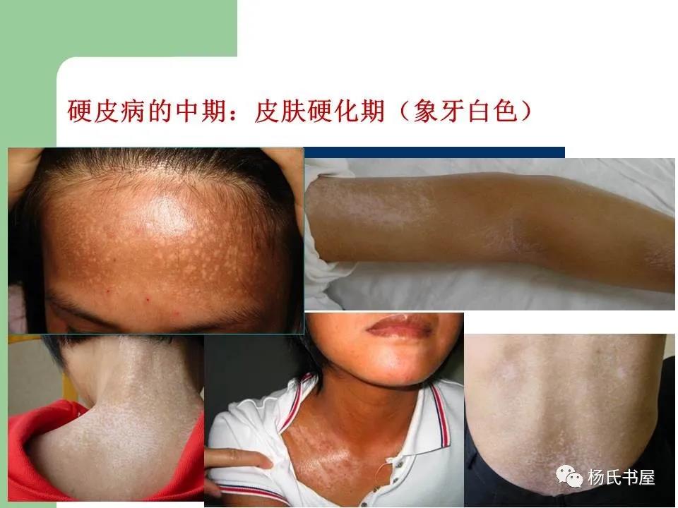 疾病科普 | 硬皮病的临床诊治经验 - 紫贝壳公益