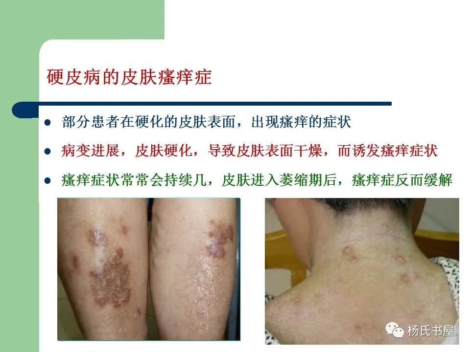 疾病科普 | 硬皮病的临床诊治经验 - 紫贝壳公益